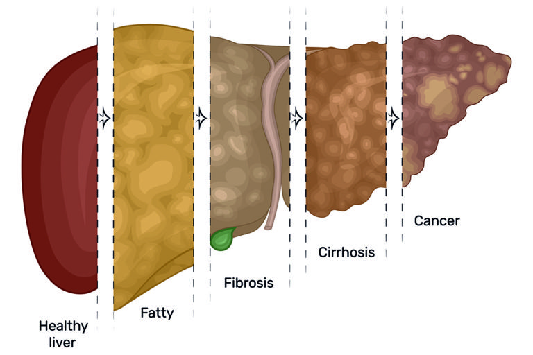 Liver Disease And Failure – St. Anthony's Hospice